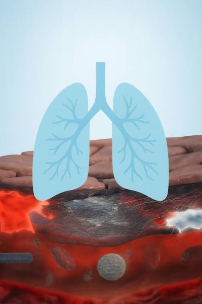 Идиопатический лёгочный фиброз